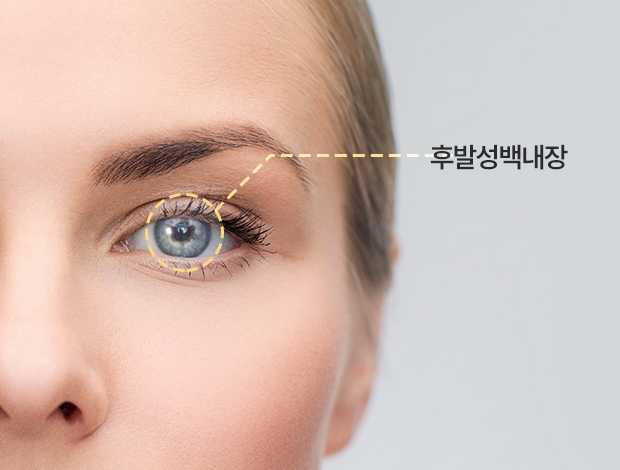 백내장