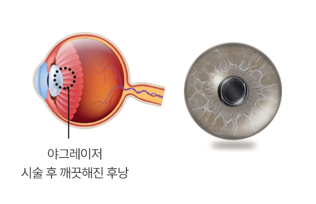 정상 안구