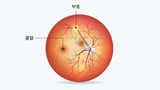급성(폐쇄각) 녹내장