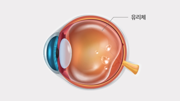 생리적인 비문증