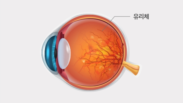 병적 비문증