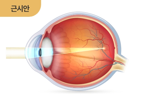 근시안
