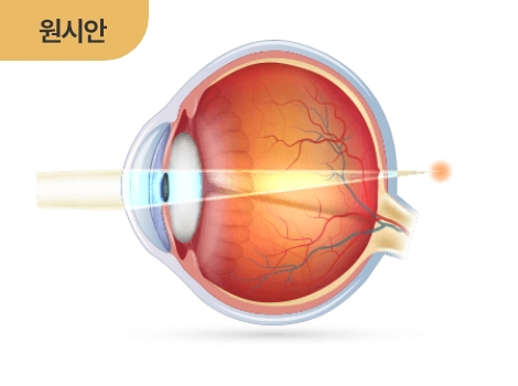 원시안