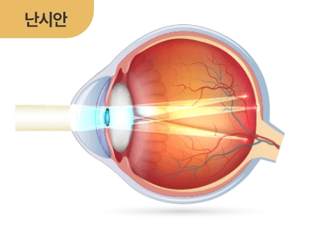 난시안