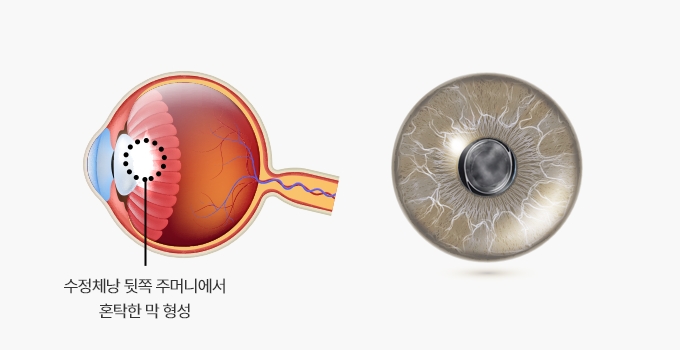 후발성 백내장 안구