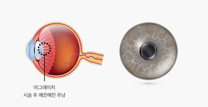 정상 안구