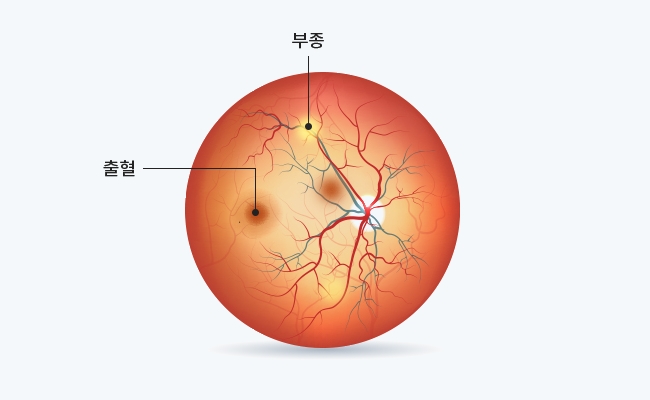 급성(폐쇄각) 녹내장